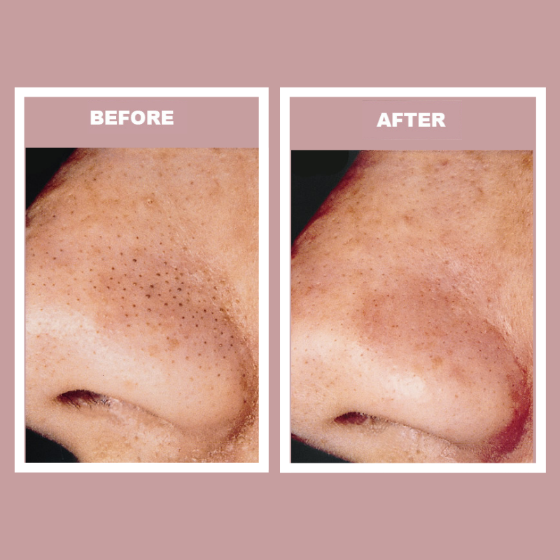 before after microdermabrasion